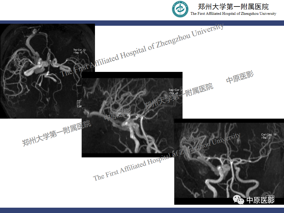 影像PPT - 【病例】颈动脉海绵窦瘘1例MR影像-8