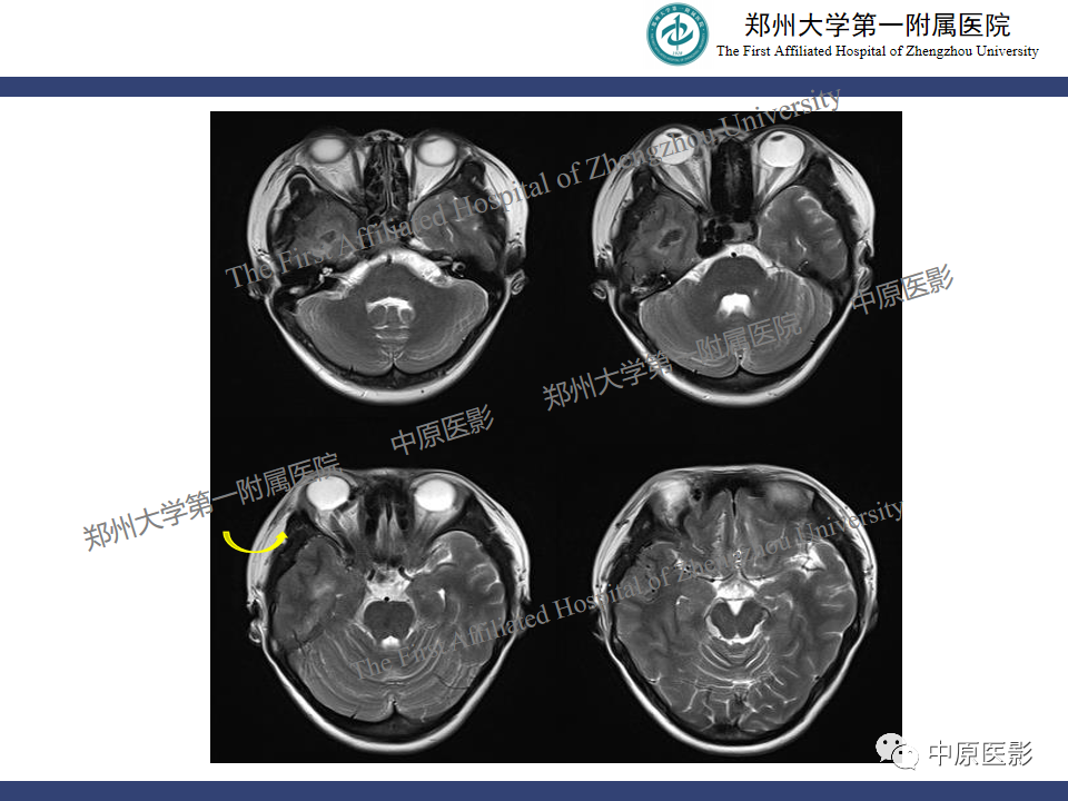 影像PPT - 【病例】颈动脉海绵窦瘘1例MR影像-3