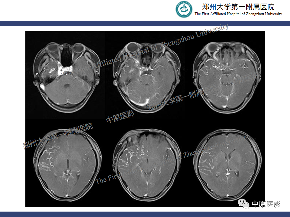 影像PPT - 【病例】颈动脉海绵窦瘘1例MR影像-9