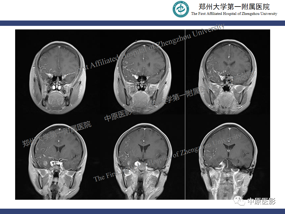 影像PPT - 【病例】颈动脉海绵窦瘘1例MR影像-11