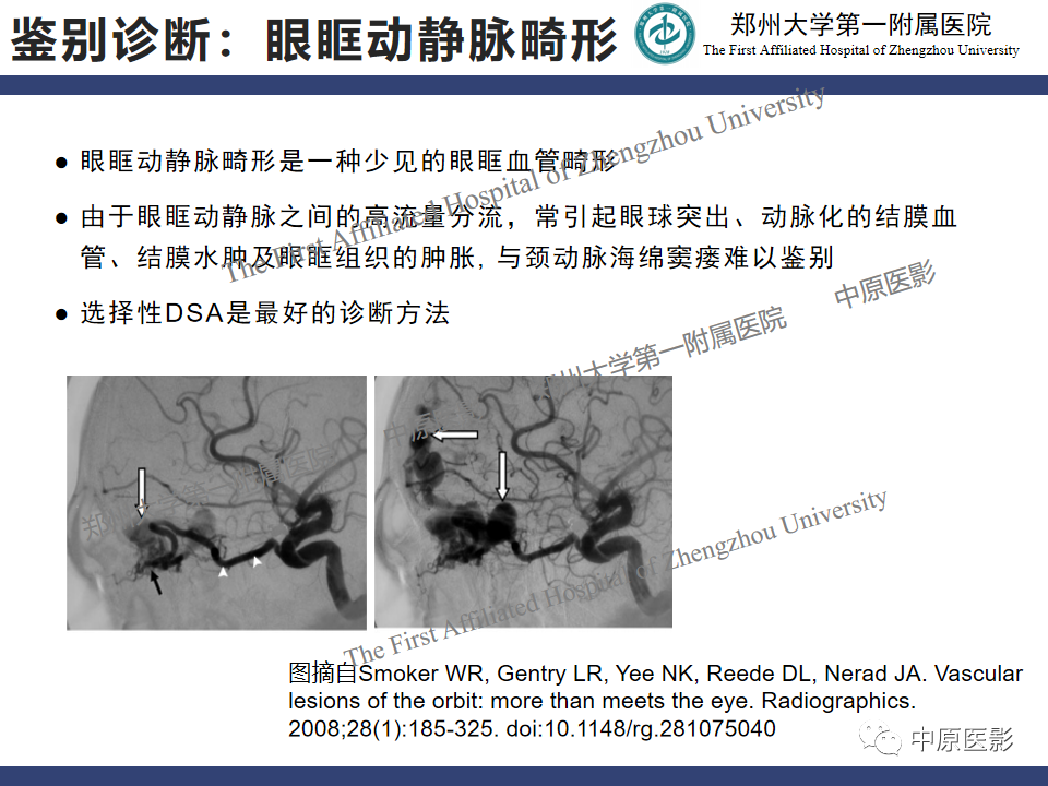 影像PPT - 【病例】颈动脉海绵窦瘘1例MR影像-21