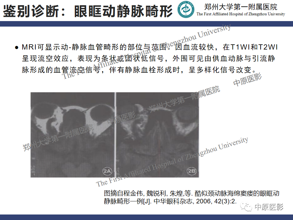 影像PPT - 【病例】颈动脉海绵窦瘘1例MR影像-22