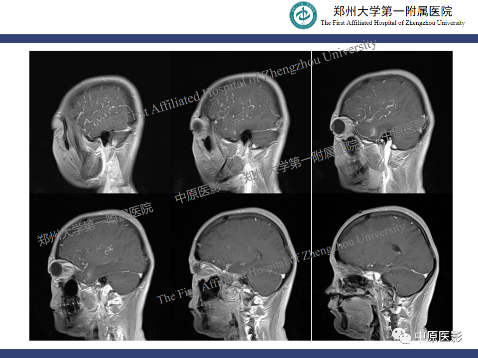 影像PPT - 【病例】颈动脉海绵窦瘘1例MR影像-10