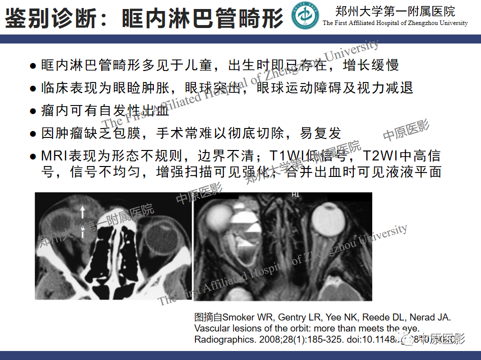 影像PPT - 【病例】颈动脉海绵窦瘘1例MR影像-23