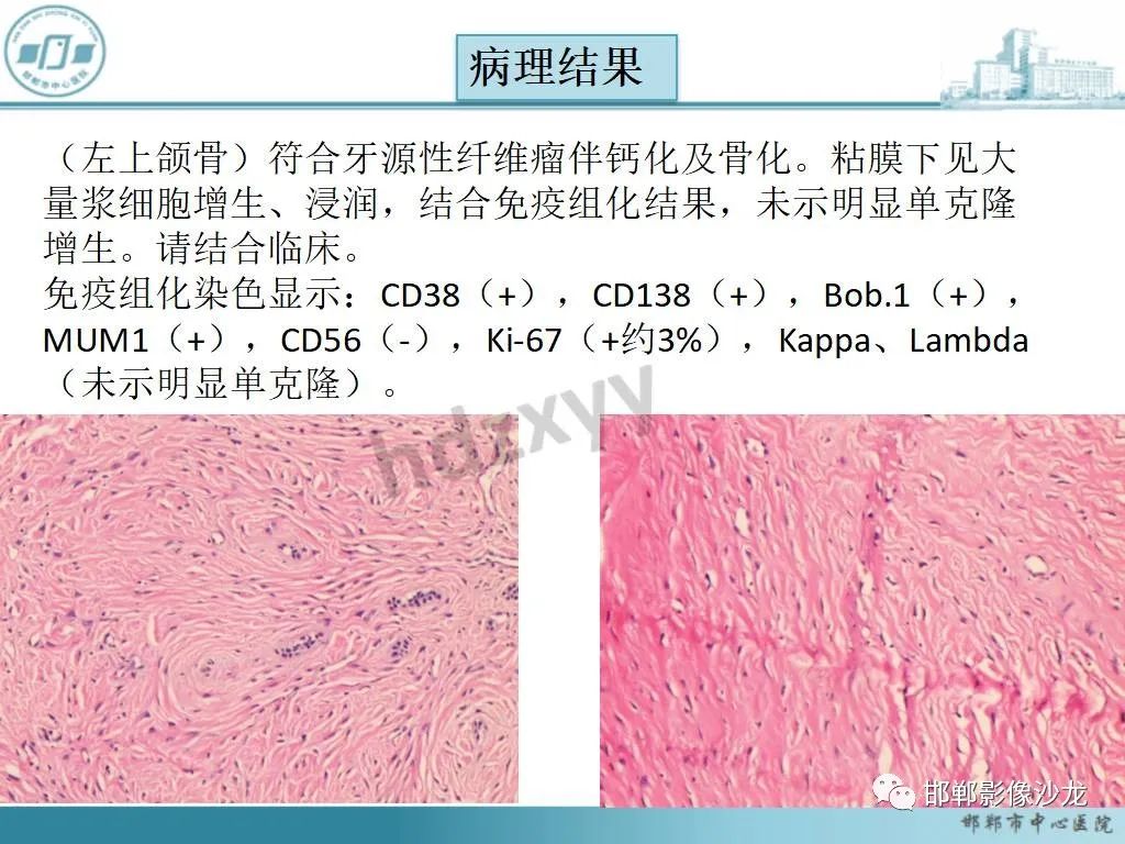 影像PPT - 【病例】牙源性纤维瘤1例CT影像诊断-6 影像PPT - 【病例】牙源性纤维瘤1例CT影像诊断-6