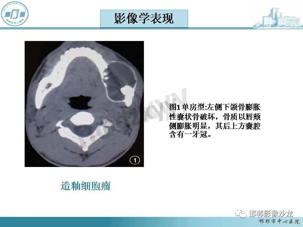 影像PPT - 【病例】牙源性纤维瘤1例CT影像诊断-16 影像PPT - 【病例】牙源性纤维瘤1例CT影像诊断-16
