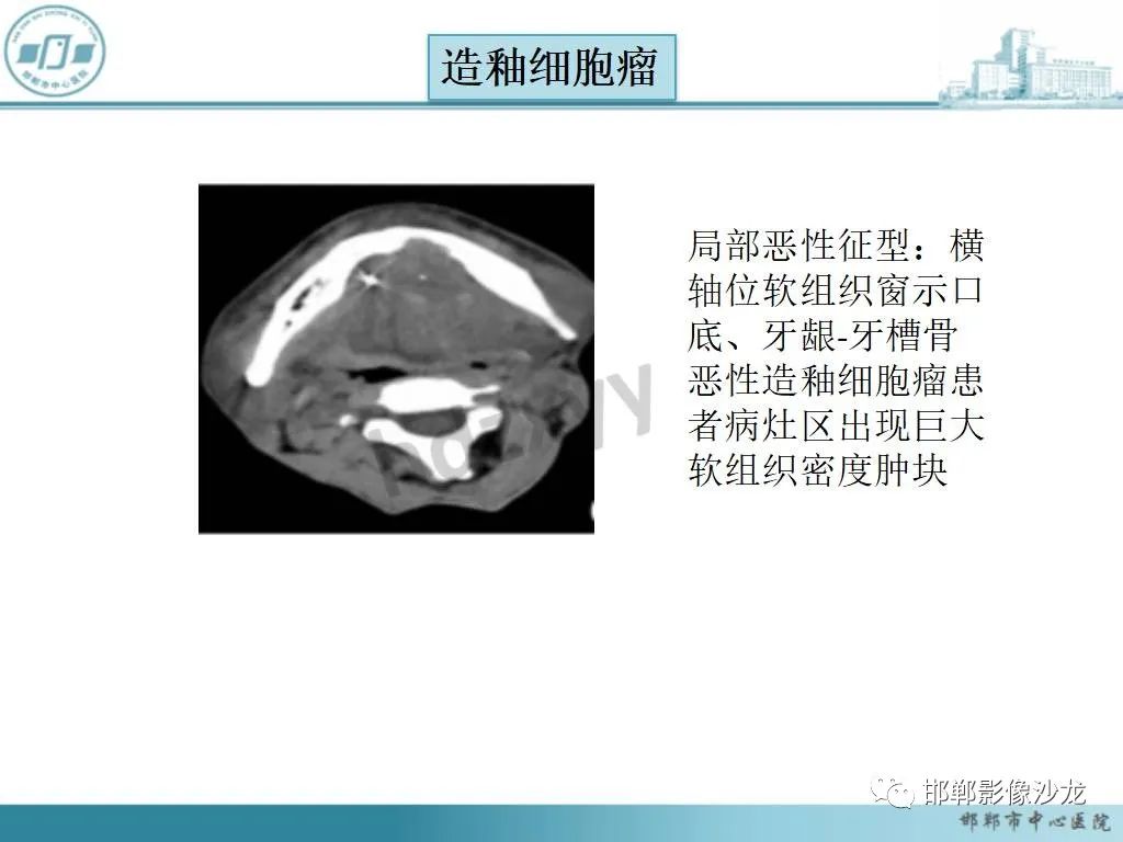 影像PPT - 【病例】牙源性纤维瘤1例CT影像诊断-17 影像PPT - 【病例】牙源性纤维瘤1例CT影像诊断-17