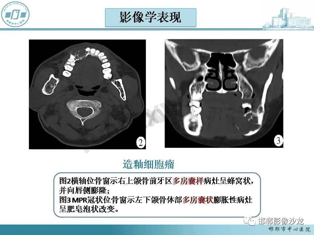 影像PPT - 【病例】牙源性纤维瘤1例CT影像诊断-14 影像PPT - 【病例】牙源性纤维瘤1例CT影像诊断-14