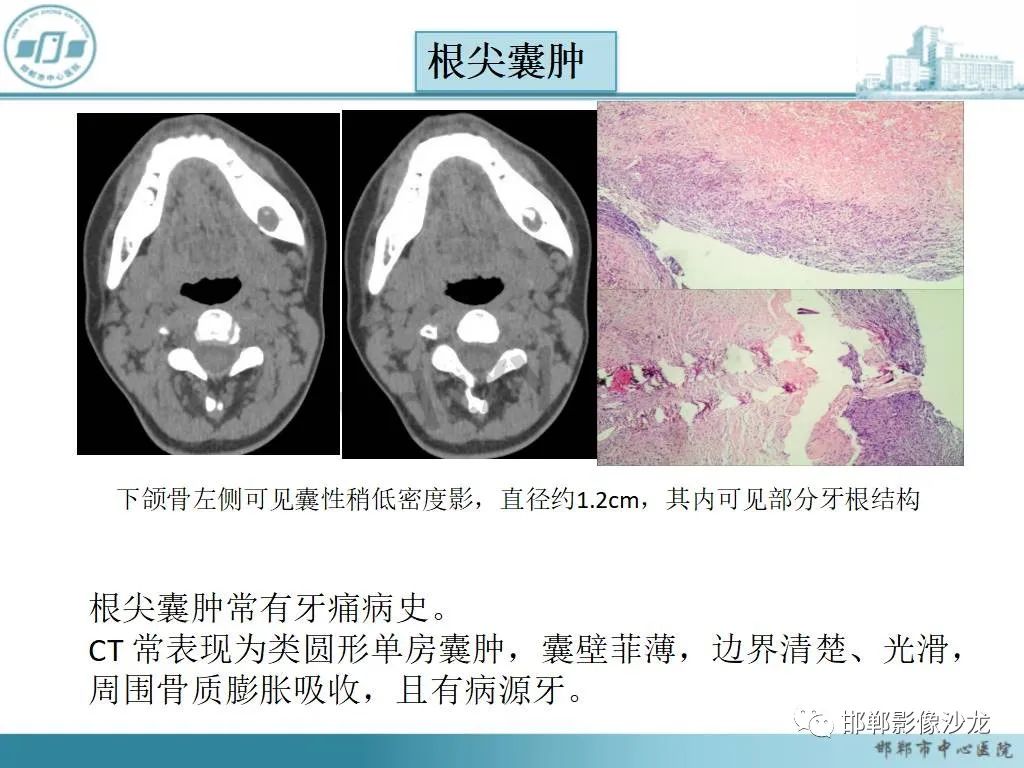 影像PPT - 【病例】牙源性纤维瘤1例CT影像诊断-19 影像PPT - 【病例】牙源性纤维瘤1例CT影像诊断-19