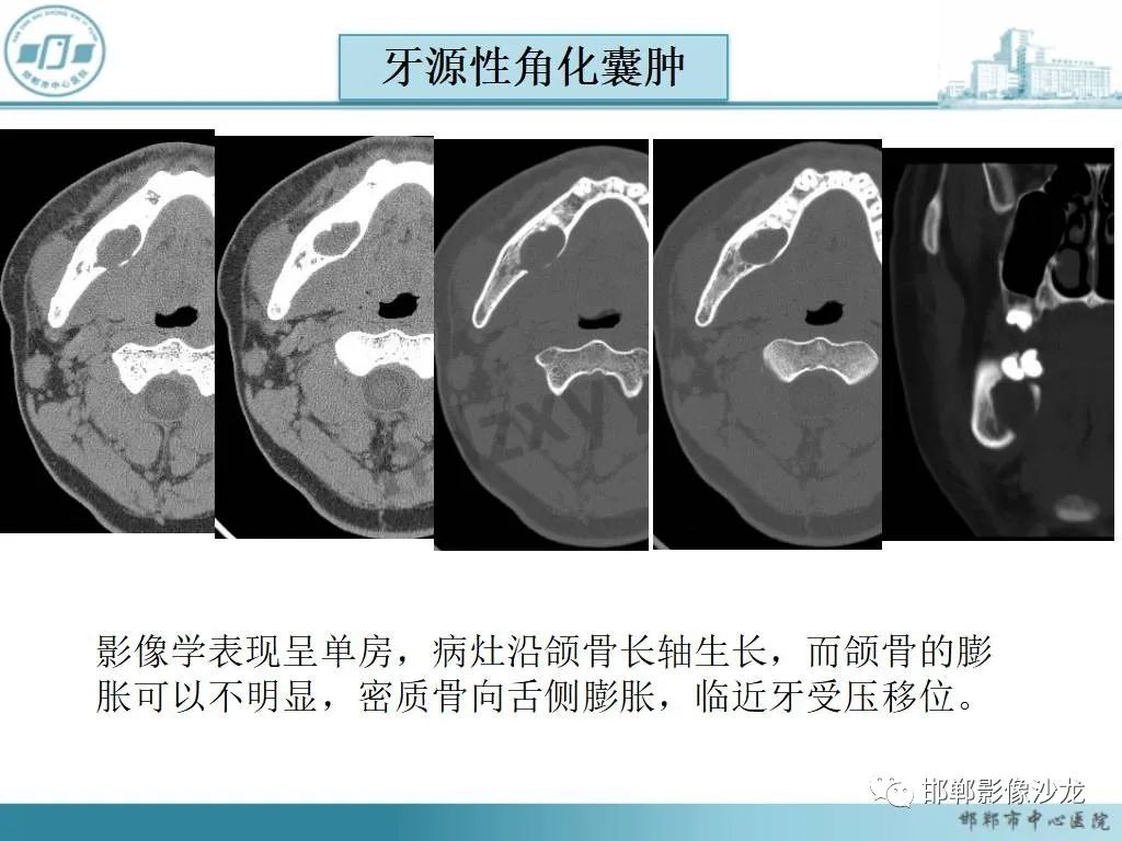 影像PPT - 【病例】牙源性纤维瘤1例CT影像诊断-23 影像PPT - 【病例】牙源性纤维瘤1例CT影像诊断-23