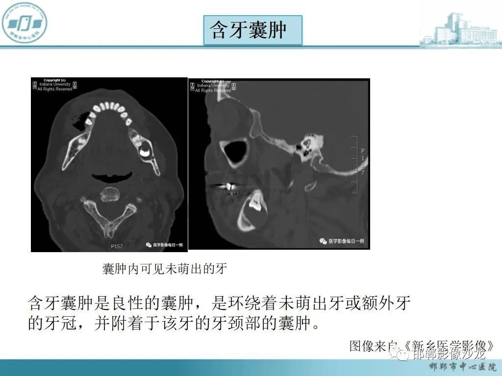 影像PPT - 【病例】牙源性纤维瘤1例CT影像诊断-21 影像PPT - 【病例】牙源性纤维瘤1例CT影像诊断-21