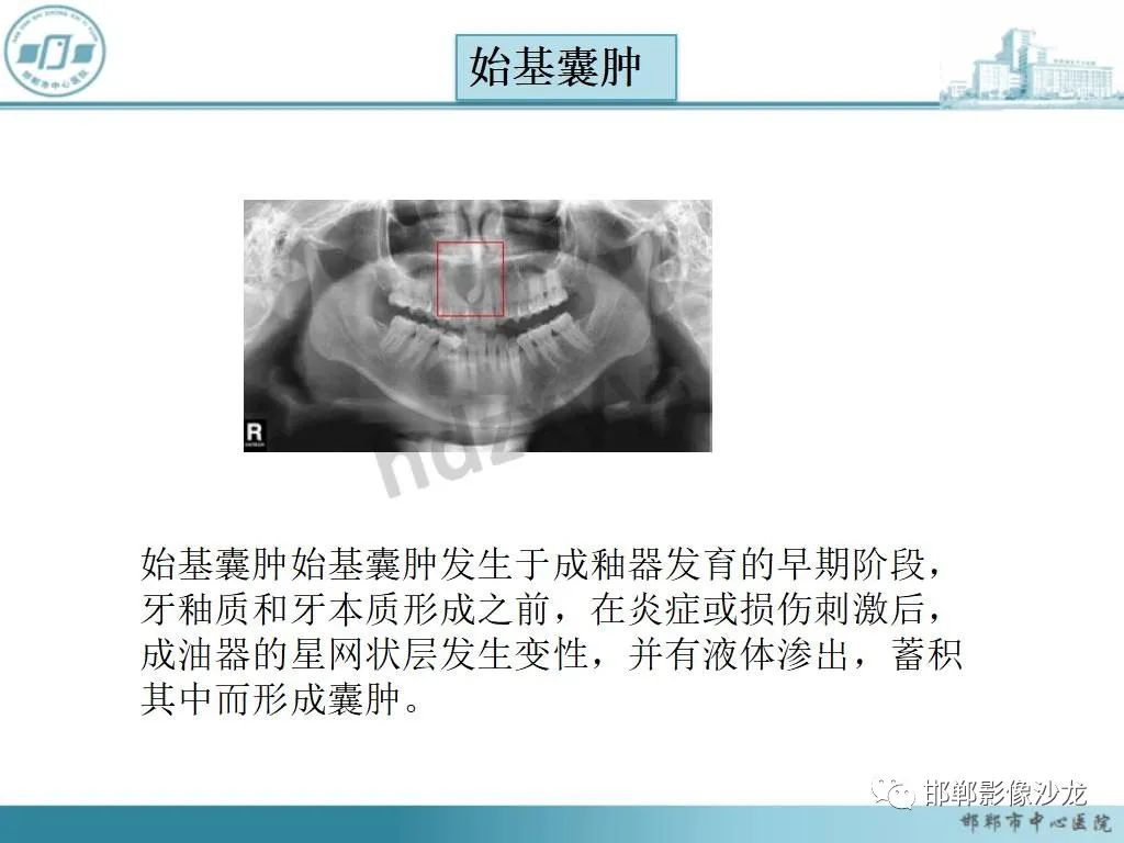 影像PPT - 【病例】牙源性纤维瘤1例CT影像诊断-22 影像PPT - 【病例】牙源性纤维瘤1例CT影像诊断-22