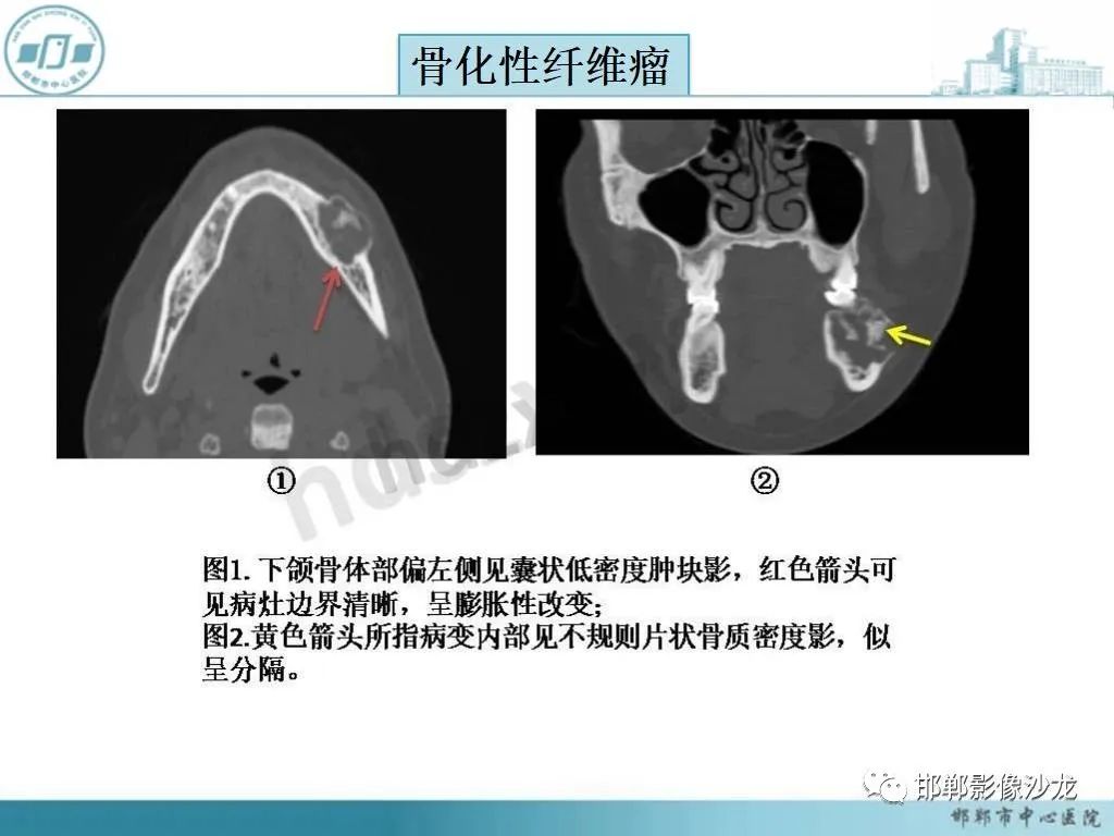 影像PPT - 【病例】牙源性纤维瘤1例CT影像诊断-30 影像PPT - 【病例】牙源性纤维瘤1例CT影像诊断-30