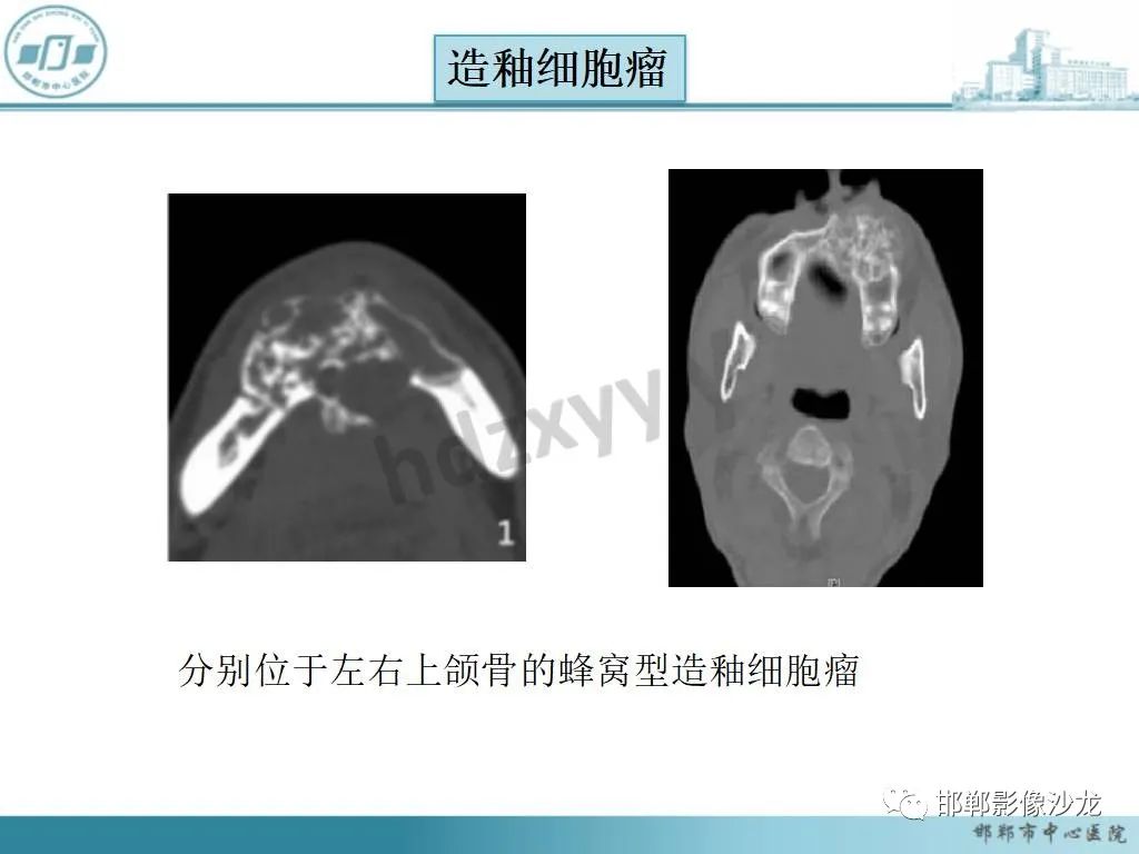 影像PPT - 【病例】牙源性纤维瘤1例CT影像诊断-2 影像PPT - 【病例】牙源性纤维瘤1例CT影像诊断-2