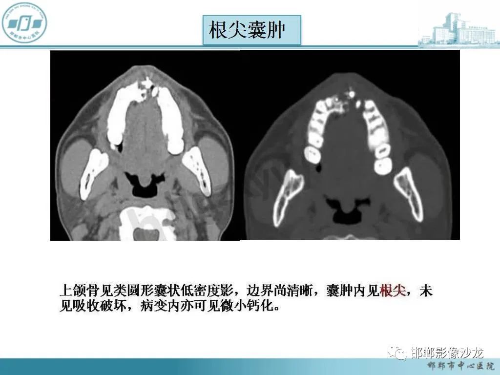 影像PPT - 【病例】牙源性纤维瘤1例CT影像诊断-3 影像PPT - 【病例】牙源性纤维瘤1例CT影像诊断-3