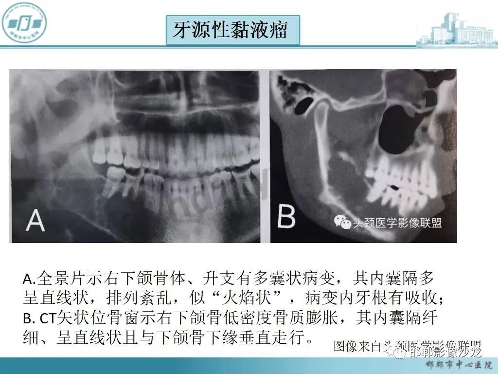 影像PPT - 【病例】牙源性纤维瘤1例CT影像诊断-4 影像PPT - 【病例】牙源性纤维瘤1例CT影像诊断-4