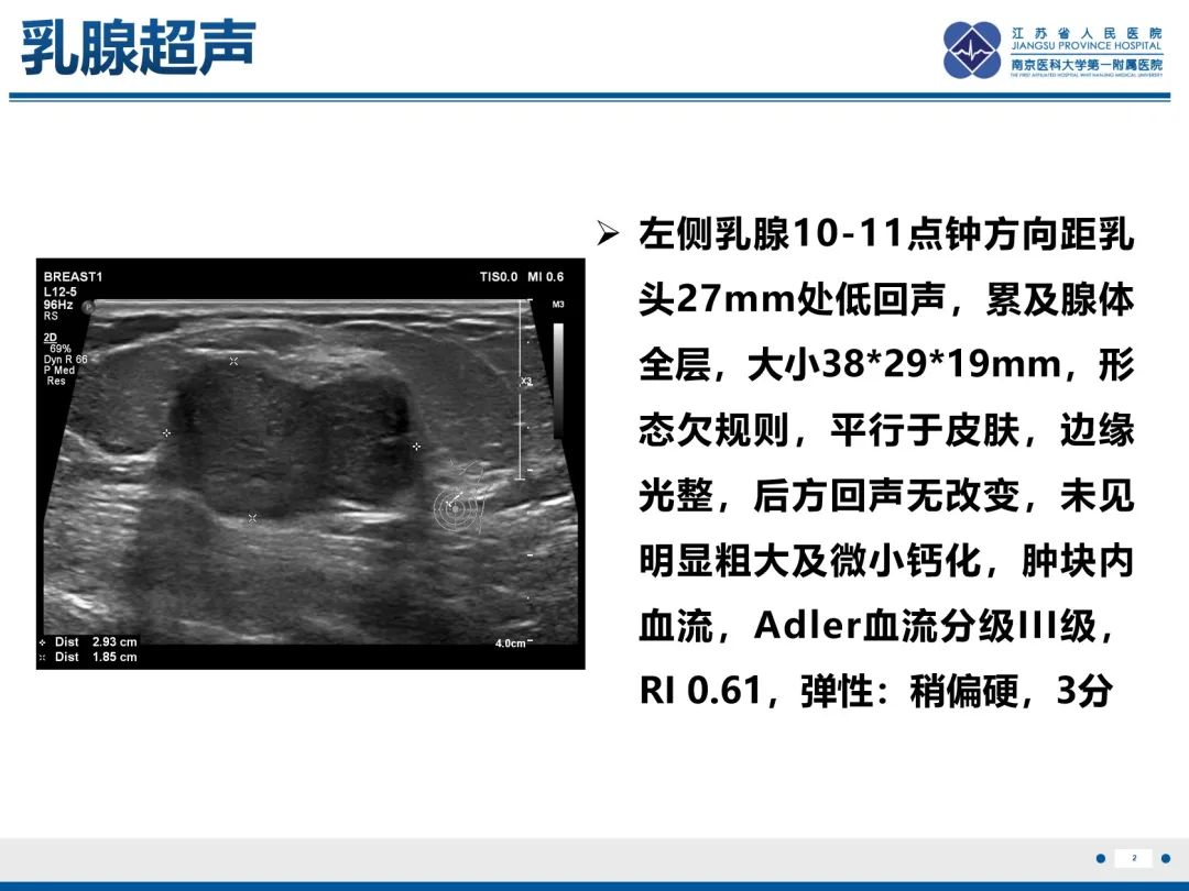 影像PPT - 【PPT】乳腺叶状肿瘤-3