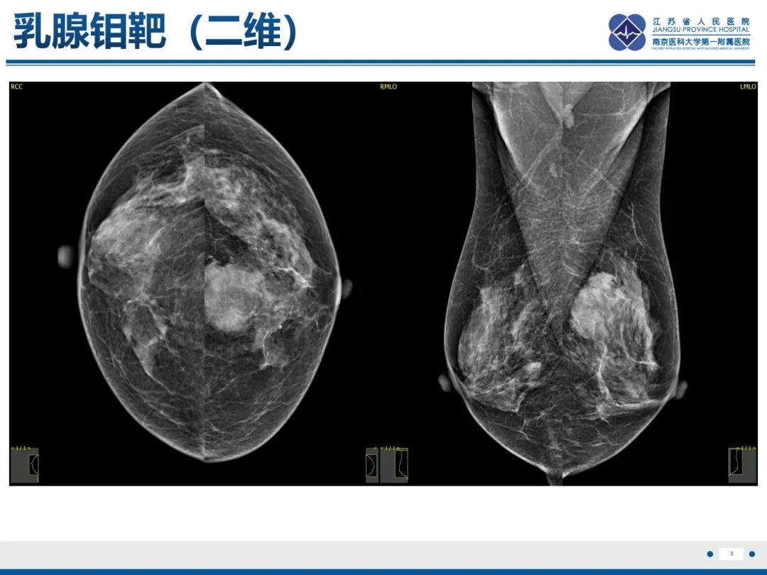 影像PPT - 【PPT】乳腺叶状肿瘤-4