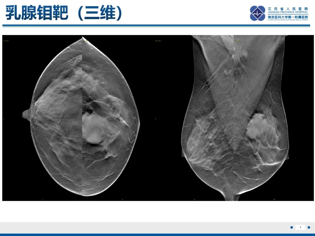 影像PPT - 【PPT】乳腺叶状肿瘤-5