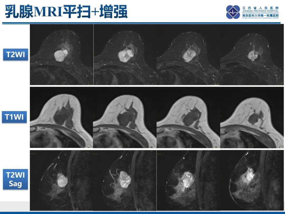 影像PPT - 【PPT】乳腺叶状肿瘤-10