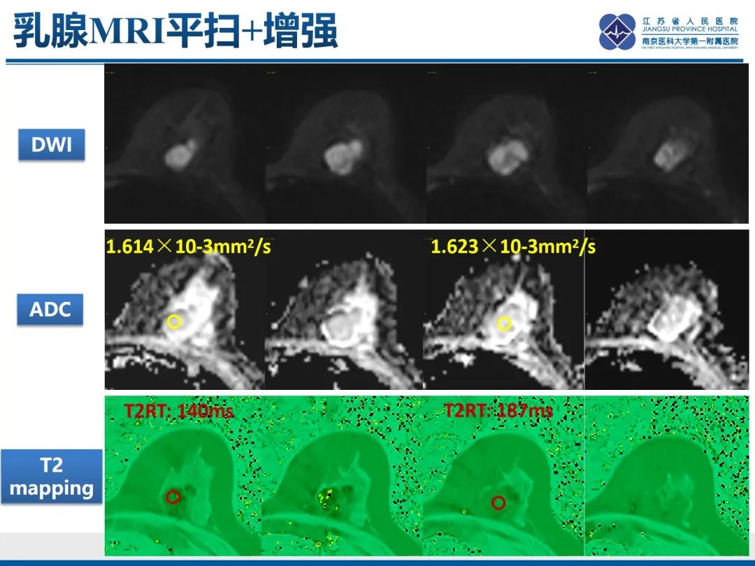 影像PPT - 【PPT】乳腺叶状肿瘤-11