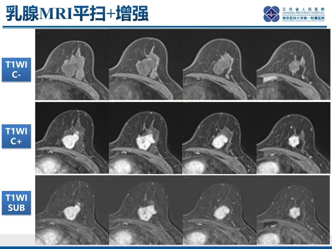 影像PPT - 【PPT】乳腺叶状肿瘤-12