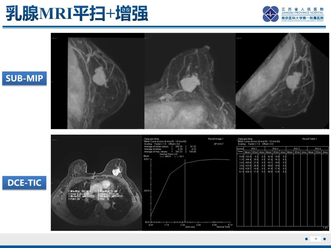 影像PPT - 【PPT】乳腺叶状肿瘤-13
