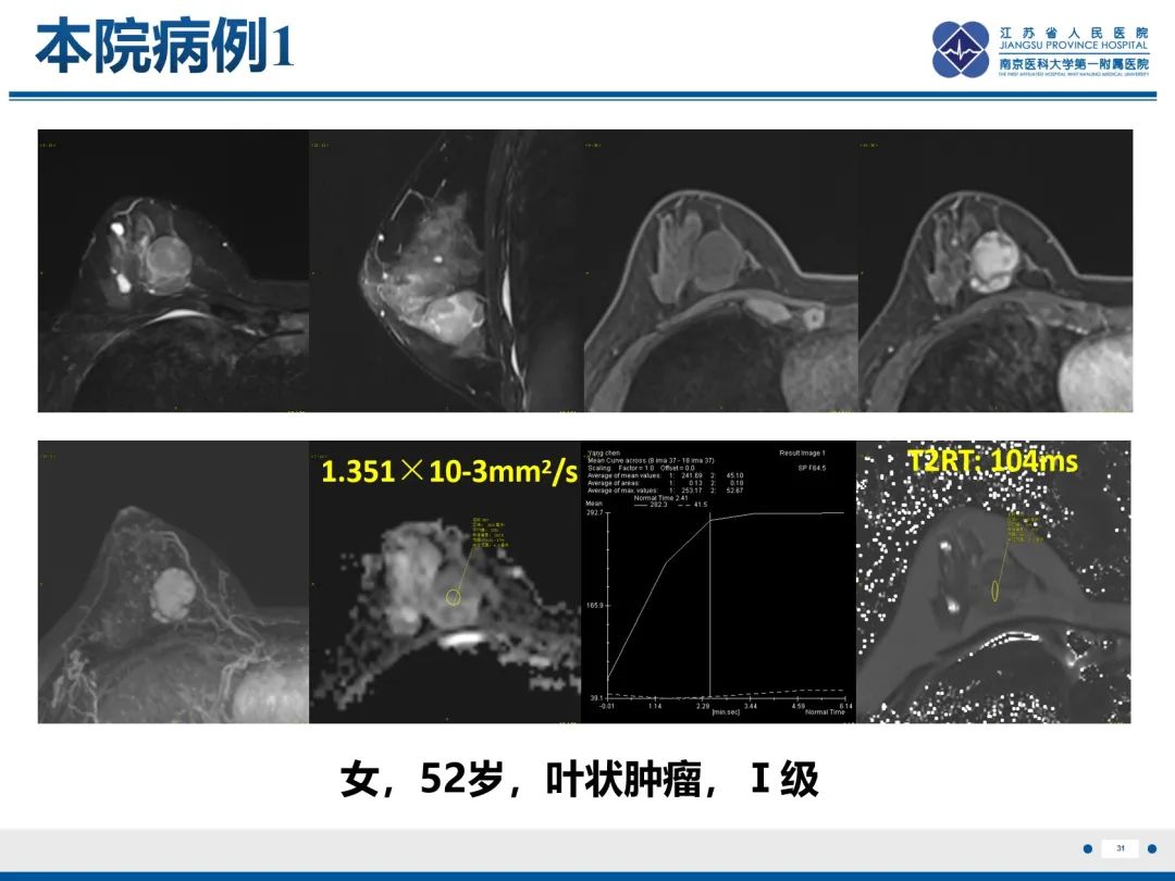影像PPT - 【PPT】乳腺叶状肿瘤-32