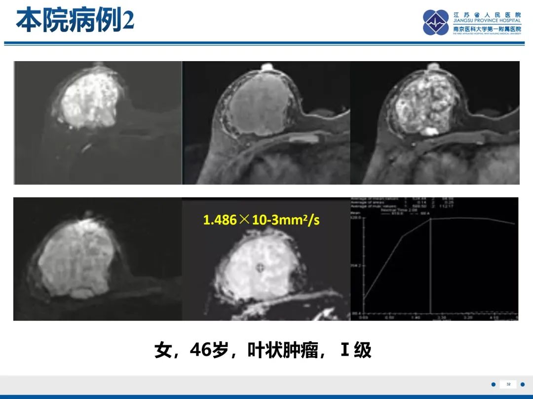 影像PPT - 【PPT】乳腺叶状肿瘤-33