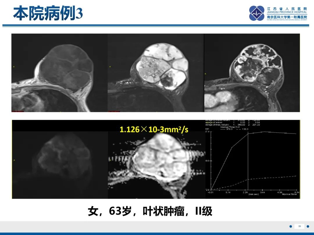 影像PPT - 【PPT】乳腺叶状肿瘤-34