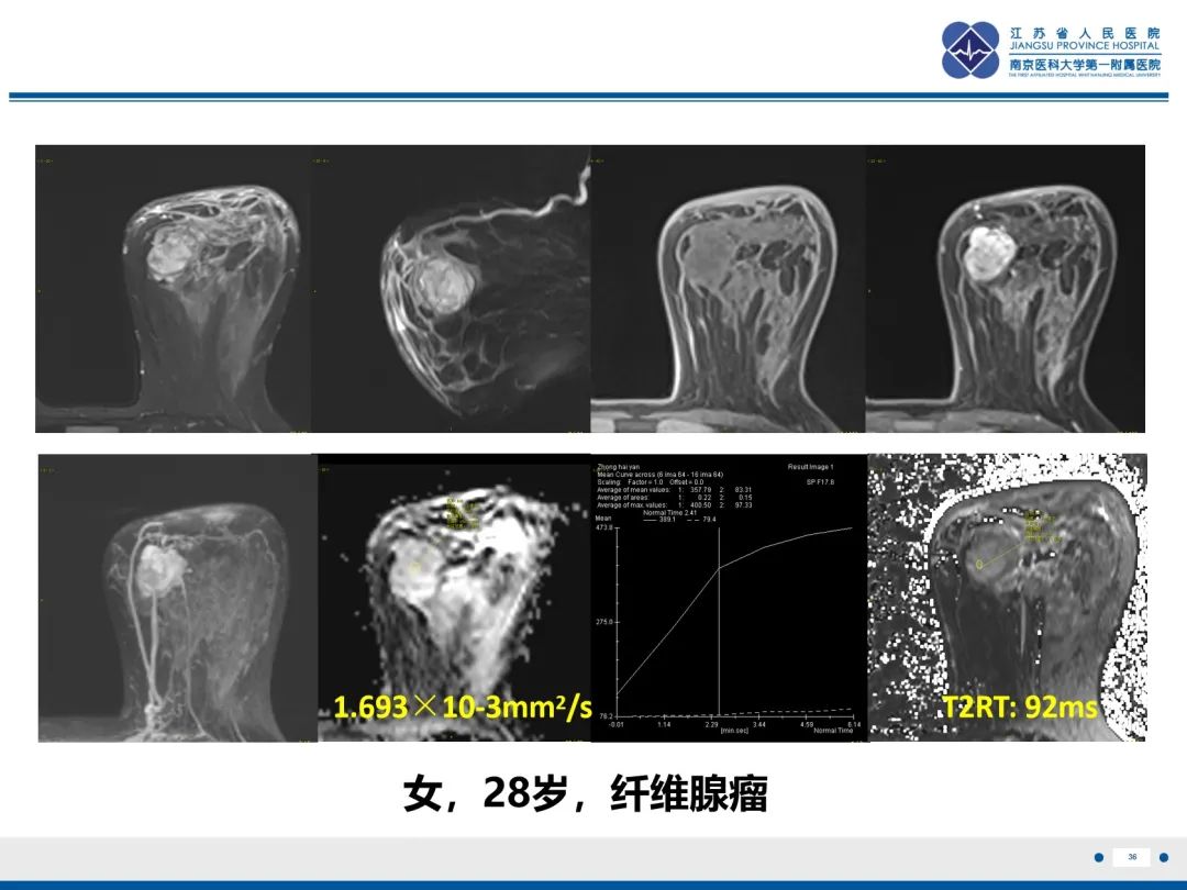 影像PPT - 【PPT】乳腺叶状肿瘤-37