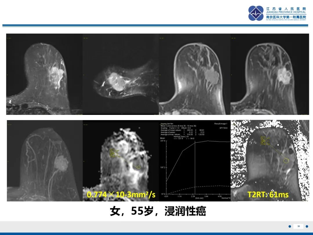 影像PPT - 【PPT】乳腺叶状肿瘤-39