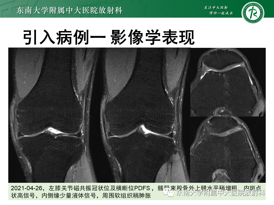影像PPT - 【PPT】髂胫束相关损伤-3