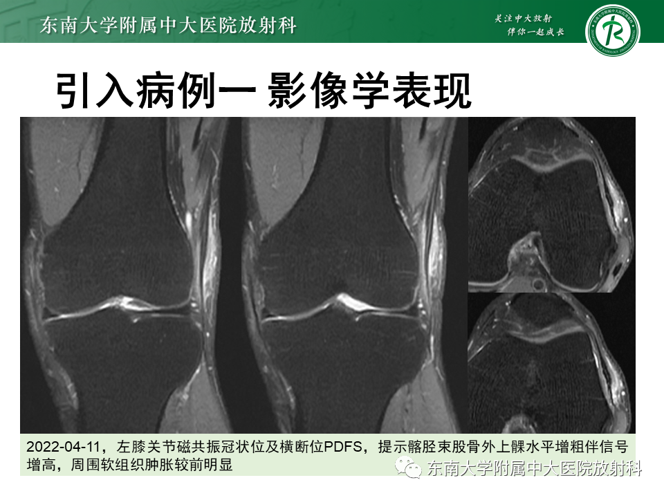 影像PPT - 【PPT】髂胫束相关损伤-4