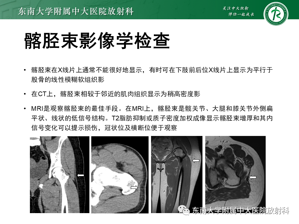 影像PPT - 【PPT】髂胫束相关损伤-9