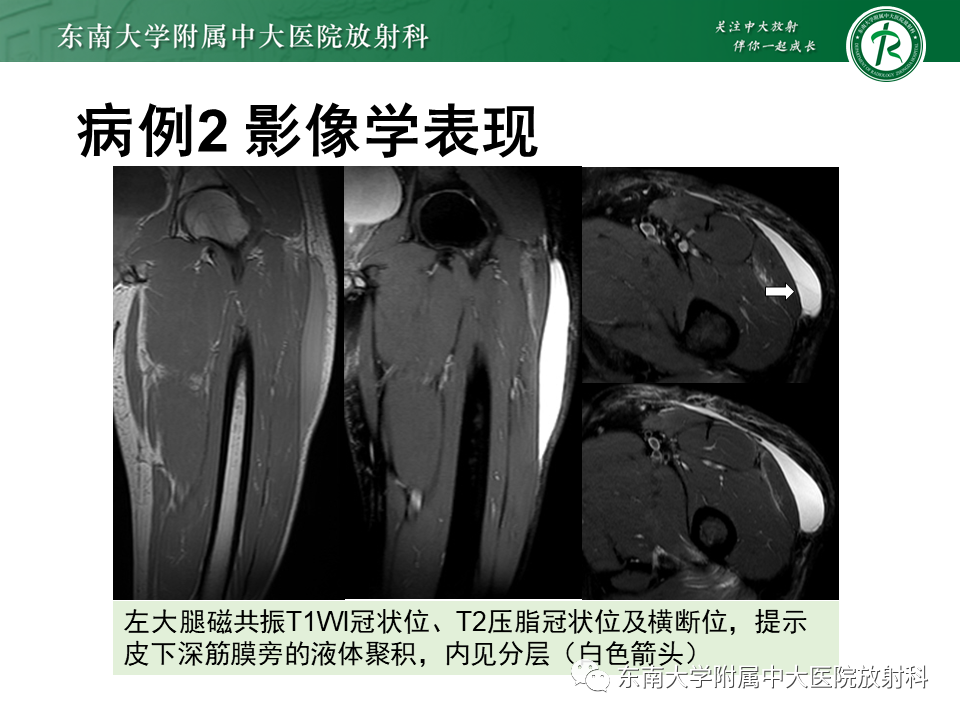 影像PPT - 【PPT】髂胫束相关损伤-24