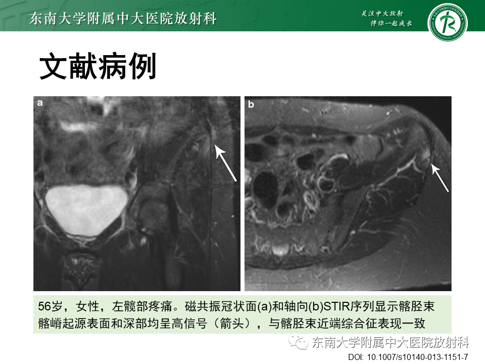 影像PPT - 【PPT】髂胫束相关损伤-30