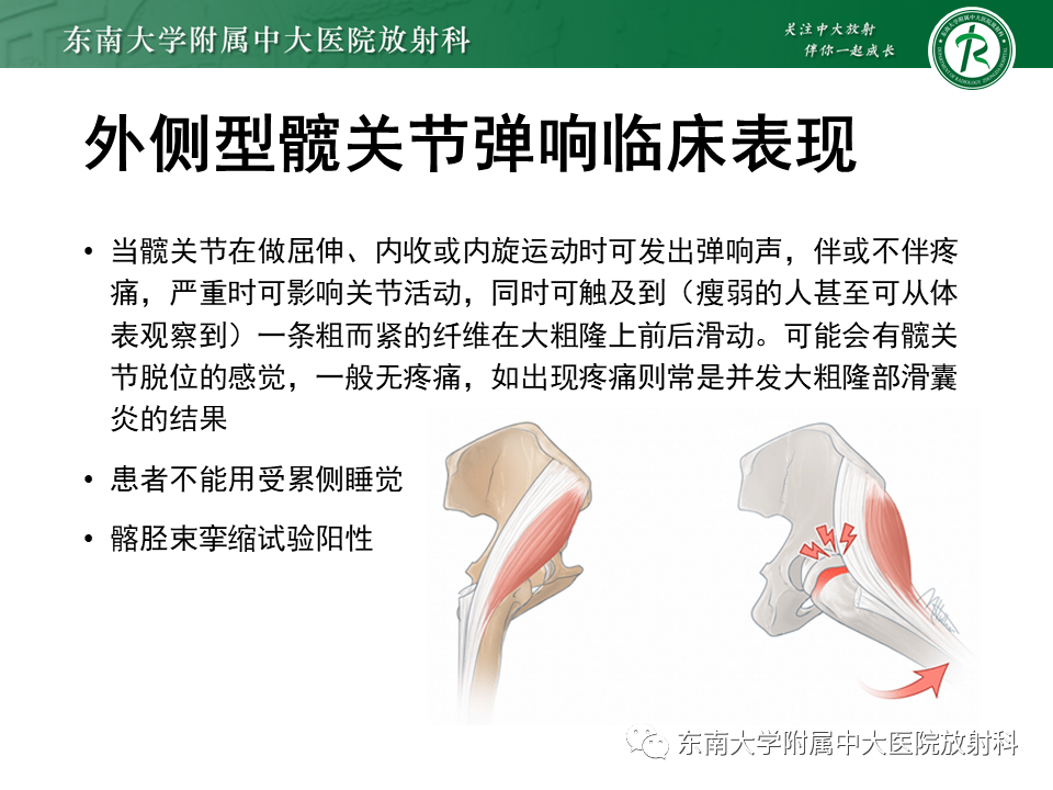 影像PPT - 【PPT】髂胫束相关损伤-32