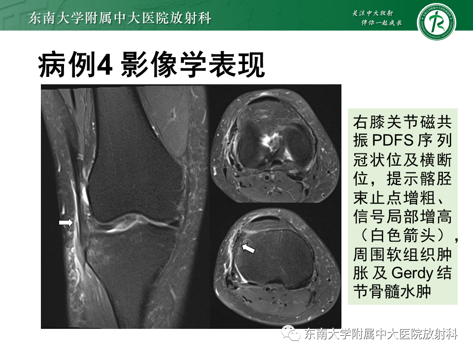 影像PPT - 【PPT】髂胫束相关损伤-38