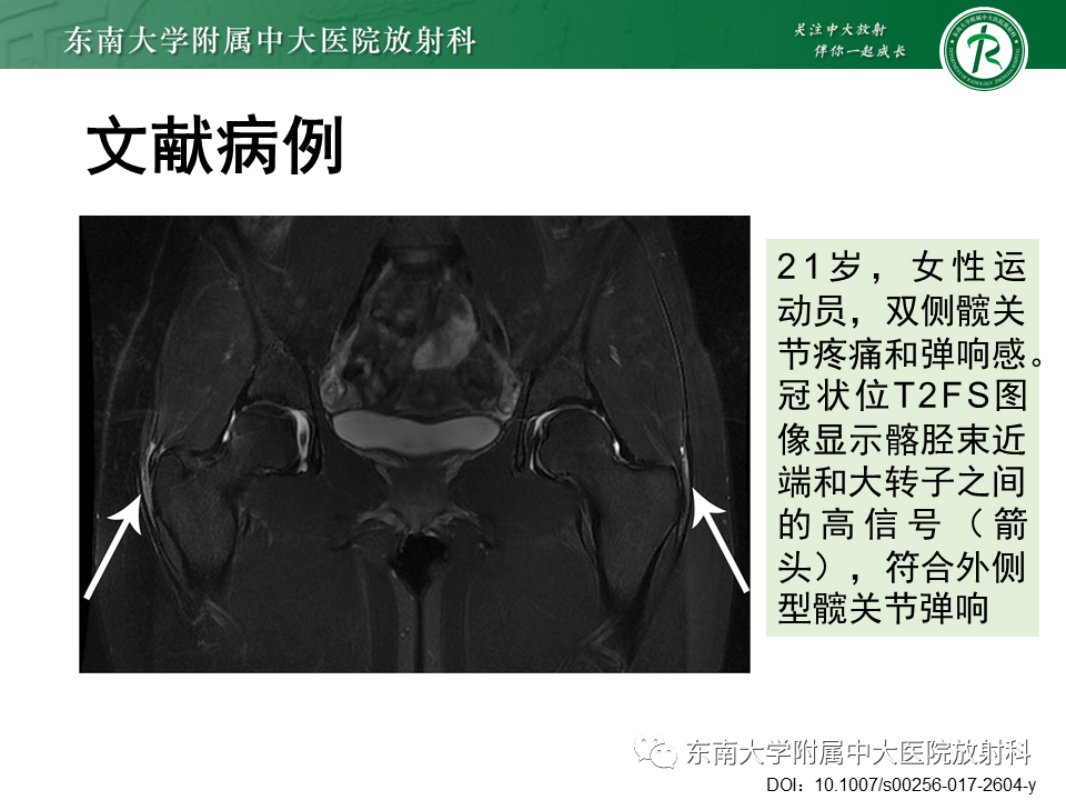 影像PPT - 【PPT】髂胫束相关损伤-34