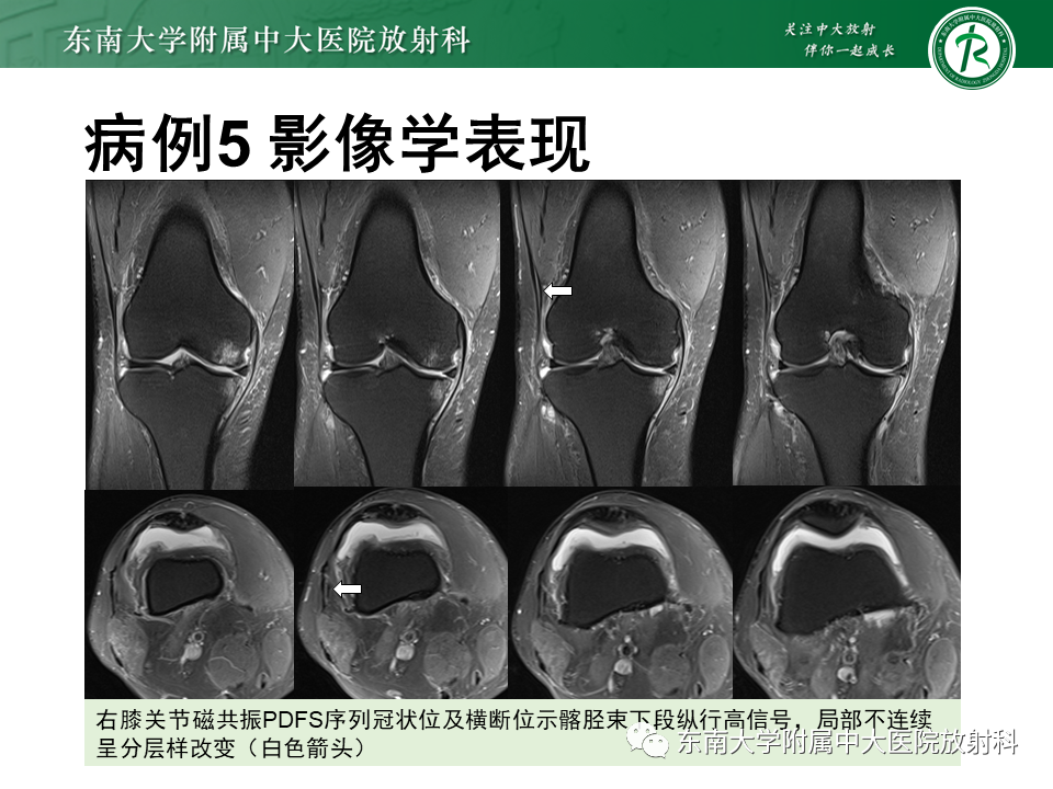 影像PPT - 【PPT】髂胫束相关损伤-42