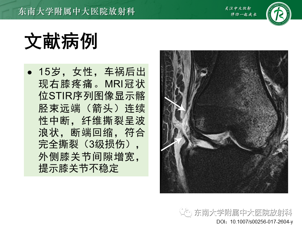 影像PPT - 【PPT】髂胫束相关损伤-43