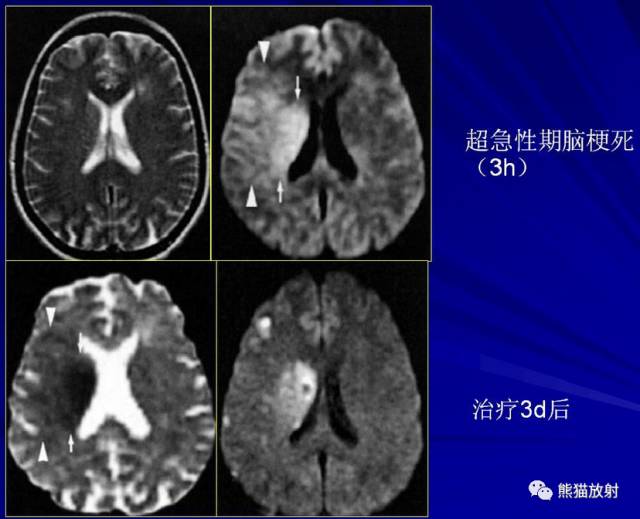 影像PPT - MR入门—手把手教你看DWI和ADC图-13 影像PPT - MR入门—手把手教你看DWI和ADC图-13