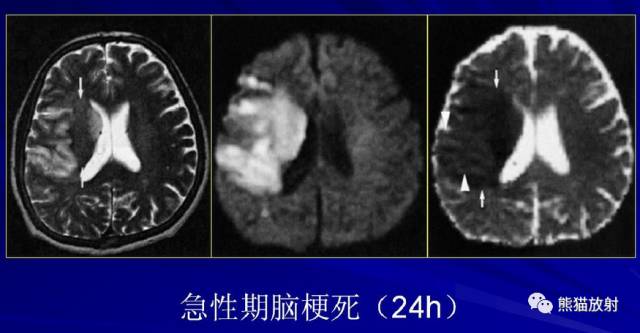 影像PPT - MR入门—手把手教你看DWI和ADC图-14 影像PPT - MR入门—手把手教你看DWI和ADC图-14