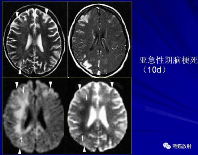 影像PPT - MR入门—手把手教你看DWI和ADC图-15 影像PPT - MR入门—手把手教你看DWI和ADC图-15