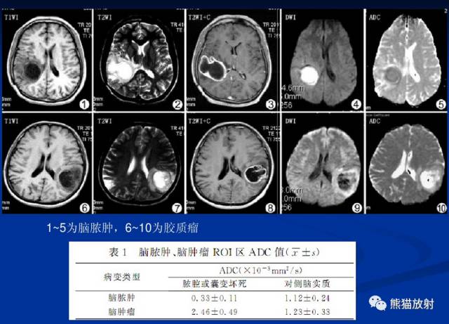 影像PPT - MR入门—手把手教你看DWI和ADC图-19 影像PPT - MR入门—手把手教你看DWI和ADC图-19