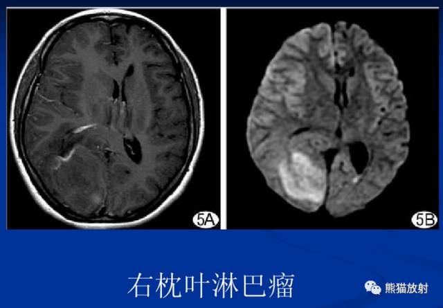 影像PPT - MR入门—手把手教你看DWI和ADC图-22 影像PPT - MR入门—手把手教你看DWI和ADC图-22