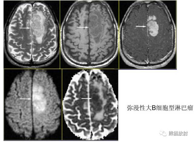 影像PPT - MR入门—手把手教你看DWI和ADC图-23 影像PPT - MR入门—手把手教你看DWI和ADC图-23