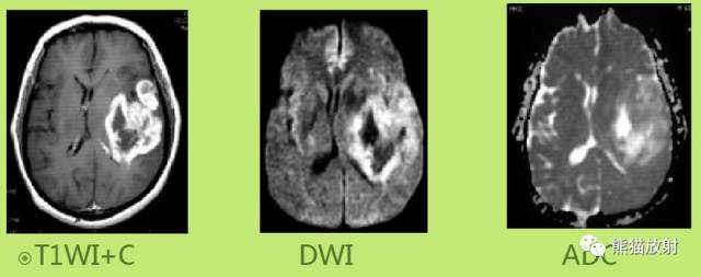 影像PPT - MR入门—手把手教你看DWI和ADC图-24 影像PPT - MR入门—手把手教你看DWI和ADC图-24