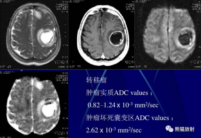 影像PPT - MR入门—手把手教你看DWI和ADC图-27 影像PPT - MR入门—手把手教你看DWI和ADC图-27
